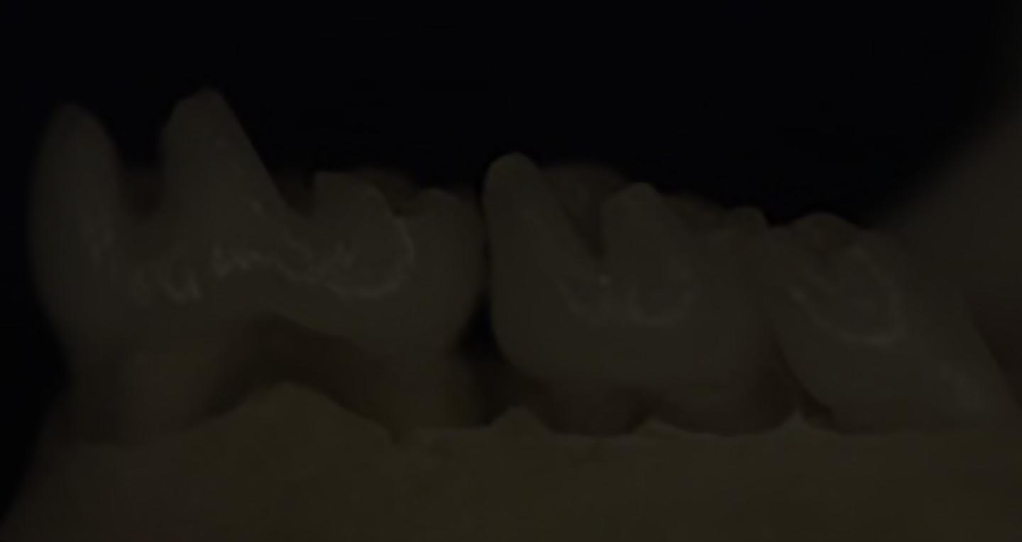 Dentinogenesis and Dentinogenesis Imperfecta